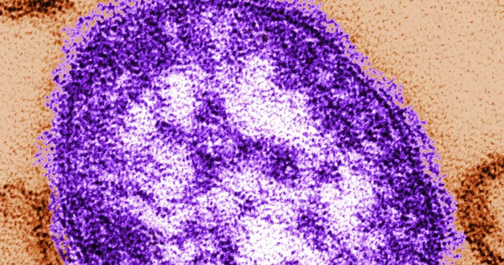 Canada is about to lose its status as having eliminated measles
