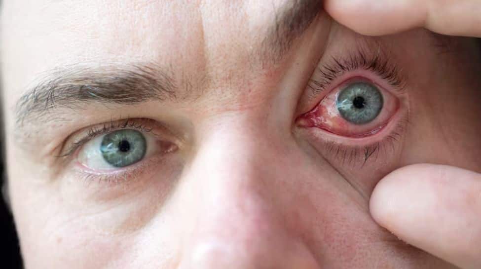 Eye Problems That Spike Due To Rising Air Pollution — And How To Spot Early Symptoms | Health News