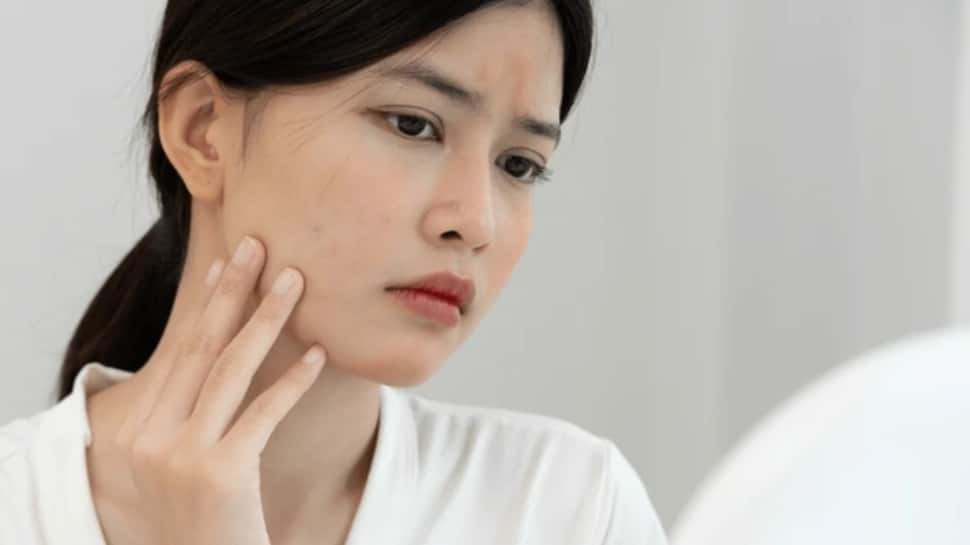 Impact Of Pollution On Skin: Why Are Dullness, Pigmentation, And Acne Increasing? | Health News