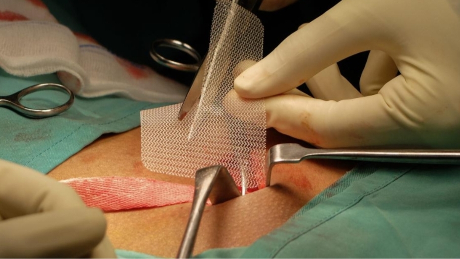 What Hernia Surgery in Brisbane Actually Does for Your Health